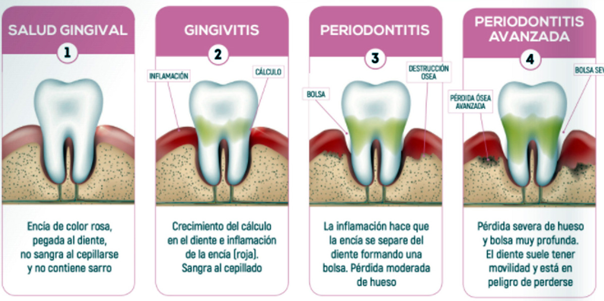 Los Problemas Periodontales Y La Caries Dental Las Enfermedades No