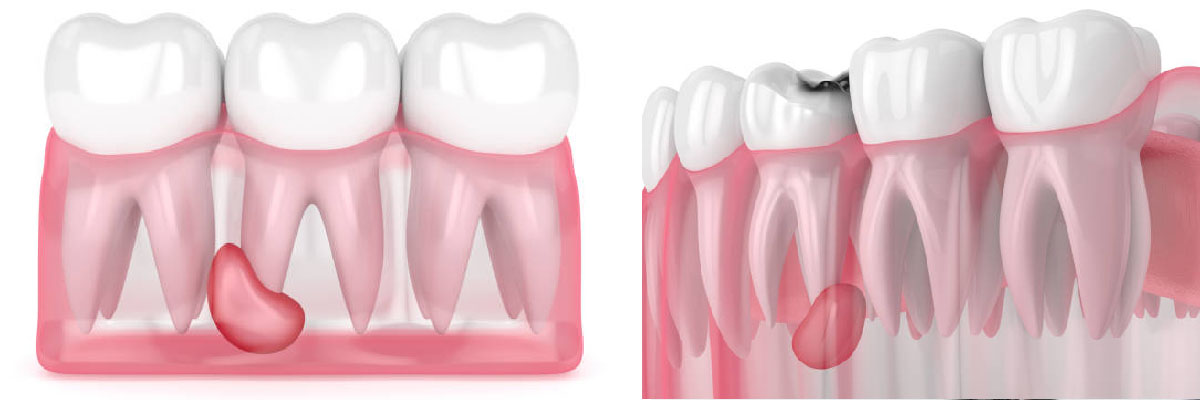 infecciones dentales