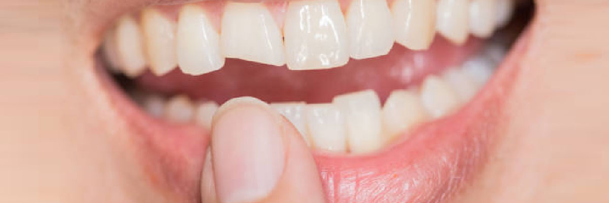 dientes fracturados o rotos