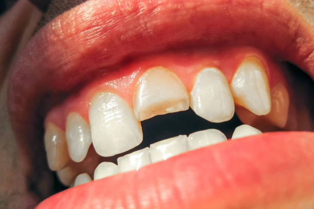 dientes fracturados o rotos 