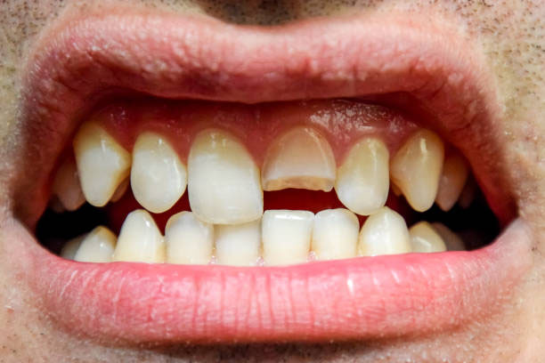dientes fracturados o rotos 