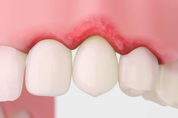 enfermedad periodontal avanzada 