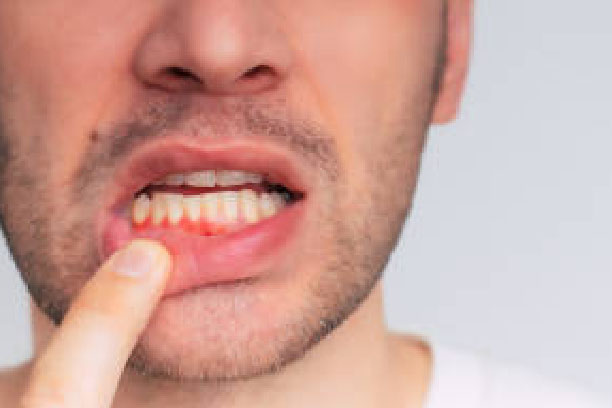 enfermedad periodontal avanzada 