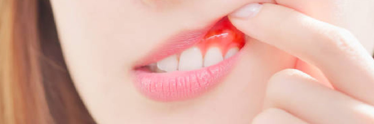 enfermedad periodontal avanzada
